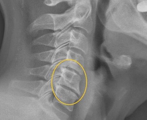 Osteochondroza kręgosłupa szyjnego na x -na