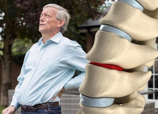 Osteochondroza wpływa na krążki międzykręgowe i powoduje ból pleców