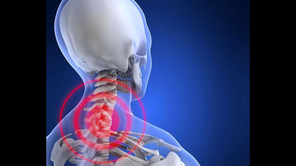Osteochondroza odcinka szyjnego kręgosłupa